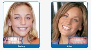 Damon Smile - Damon Braces Before And After Adults #2748780