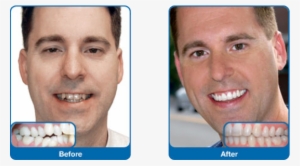 Damon Smile - Damon Braces Adults Before After #2748925