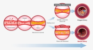 If Fibrinolytic Activity Is Decreased , Blood Clot - Nattokinase #2774053