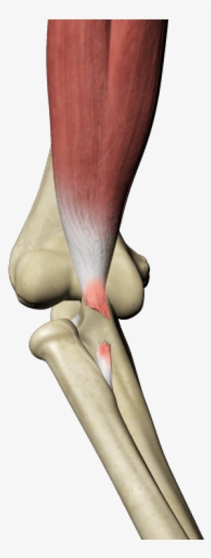 Biceps Tendon Tear - Diatal Biceps Tendon Rupture #288769