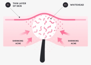 Death Of The Pimple - Acne #2882056