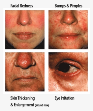 Many People Notice That Their Rosacea “flares” Or Symptoms - Red Face Stress #2882121