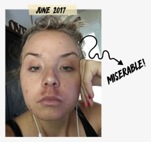 Those Little Popped Pimples You See Up There Turns - Melasma Mustache #2882210