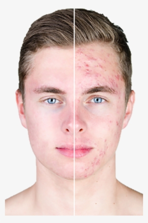 What Are Acne Treatments - Puberty Acne #2882309