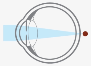 Hyperopia, Or Farsightedness, Occurs When An Eyeball - Circle #2895199