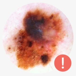 Cancerous Mole - Multi Colour Mole #293636