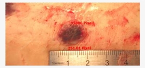 Determination Of The Area Of The Bruise In Pixel2 After - Blood #2928324