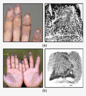 Example Images Of Altered Fingerprints - Fingerprint Alteration #2933515
