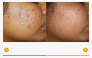 Acne Scar Revision After Tixel Treatment At Canary - Tixel For Acne Scars #2968016