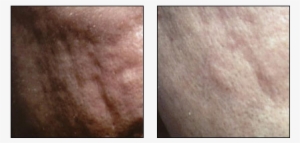 Acne Scar Treatment Results At Ablon Skin Institute - Scar #2968198