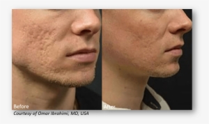 Benefits Of Infini Rf Microneedling - Results Of Rf Microneedling #2968305