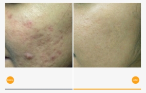 Acne Scars Treatment - Tixel Before And After Acne Scars #2968361