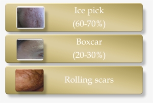 Picture14 - Boxcar Ice Pick Scars #2968501