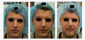 Acne And Acne Scarring And Pores Before , 2 Months - Acne #2968532