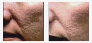 Acne Scar Treatments By Dr - Dr. Glynis R. Ablon, Md #2968689