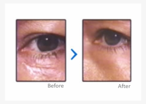 Scar Treatment Results - Contact Lens #2968740