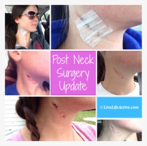 Branchial Cleft Cyst Removal Surgery Scar - Branchial Cyst Surgery Scar #2968783