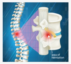 Our Chiropractors In Tucson Offer Treatment For Pinched - Area Spinal Column #2970428