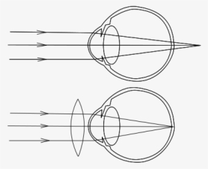 Los Rayos De Luz Que Inciden En El Ojo, Enfocan Por - Hypermetropia #2977089
