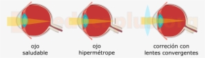 Correción De La Hipermetropía - Lentes Convergentes Para Hipermetropia #2977260