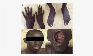 Clinical Anomalies Of A Patient - High-arched Palate #2990654