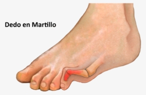 Causas - Hammer Toe #3036326