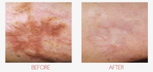 Feel Confident With Your Skin - Scar #3178731