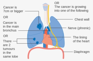 Lung Cancer Stages Pictures - Lung Cancer Staging #3181839