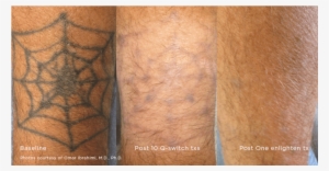 Tattoo Removal* - Tattoo #3193664