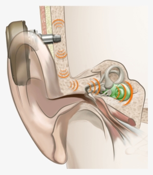 Bahs What Is Bone Conduction How It - Bone Conduction #322682