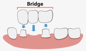 Dental Bridges Illustration - Dental Bridge Illustration #323799