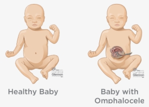 Typically, During Week 6 To 10 Of Pregnancy, A Baby's - Pulmonary Hypoplasia #3286171