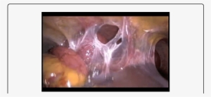 Photograph Showing The Dilated Small Intestines Trapped - Small Intestine #3286174