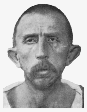 Schizophrenia Congenital Idiot, Age - Wikimedia Commons #3293169