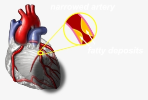 A Severe Heart Attack Can Cause Permanent Damage To - Rheumatoid Arthritis Affect Heart #3335855