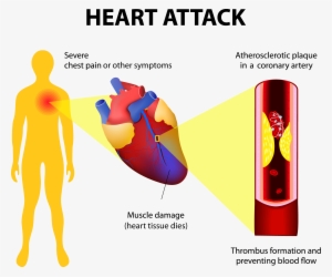 Heart-attack2 Adobestock - Myocardial Infarction Full Body #3336087