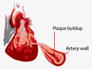 Myocardial Infarction #3336164 Myocardial Infarction #3336164