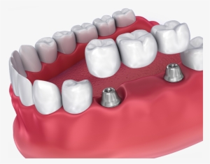 Dental Crowns #3391114