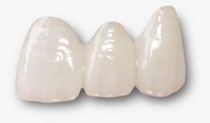 Ceramic Dental Bridges - Emax Crown #3391491