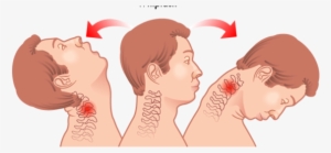 Whiplash Injuries Cause Pain - Whiplash Injury #3451118