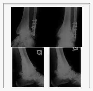 Ap, Mortise And Flexion Extension X Rays Of An Osteoarthritic ...