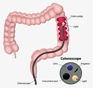 Colonoscopy - Colon Cancer #3521752