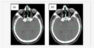 The Landmark Location On The Fixed And (b) - Computed Tomography #3522325