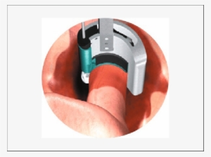 Schematic Show Of The Curvilinear Cut Of The Colon - Large Intestine #3522471