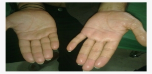 Difference Between Left Sympathectomised And Right - Ring #3540540