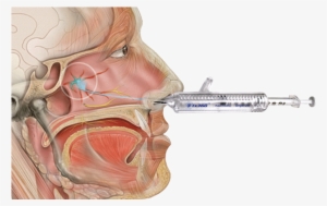 Headache/migraine Program - Mirx Protocol - Nasal Applicator #3542256