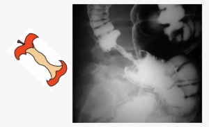 Colorectal Cancer Barium Enema #3552084