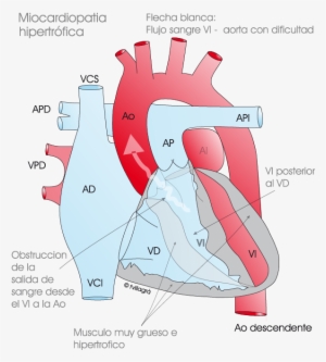 Miocardiopatía Hipertrófica - Mch Obstructiva #3555975