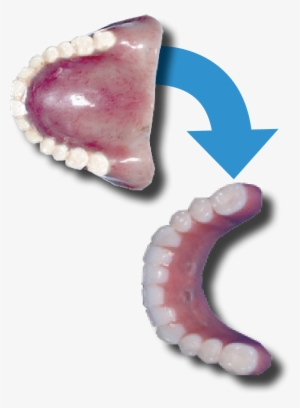 Implants There Is No Need For Thick, Long Flanges On - Insect #3601257