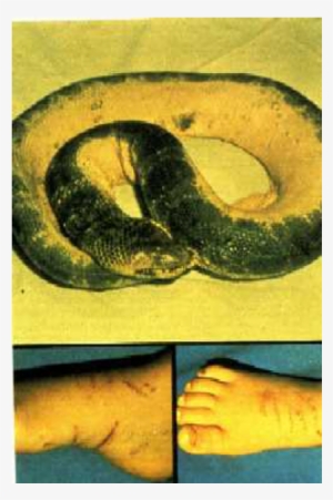 Photo Of Wounds Inflicted On The Victim And The Snake - Photograph #3670780